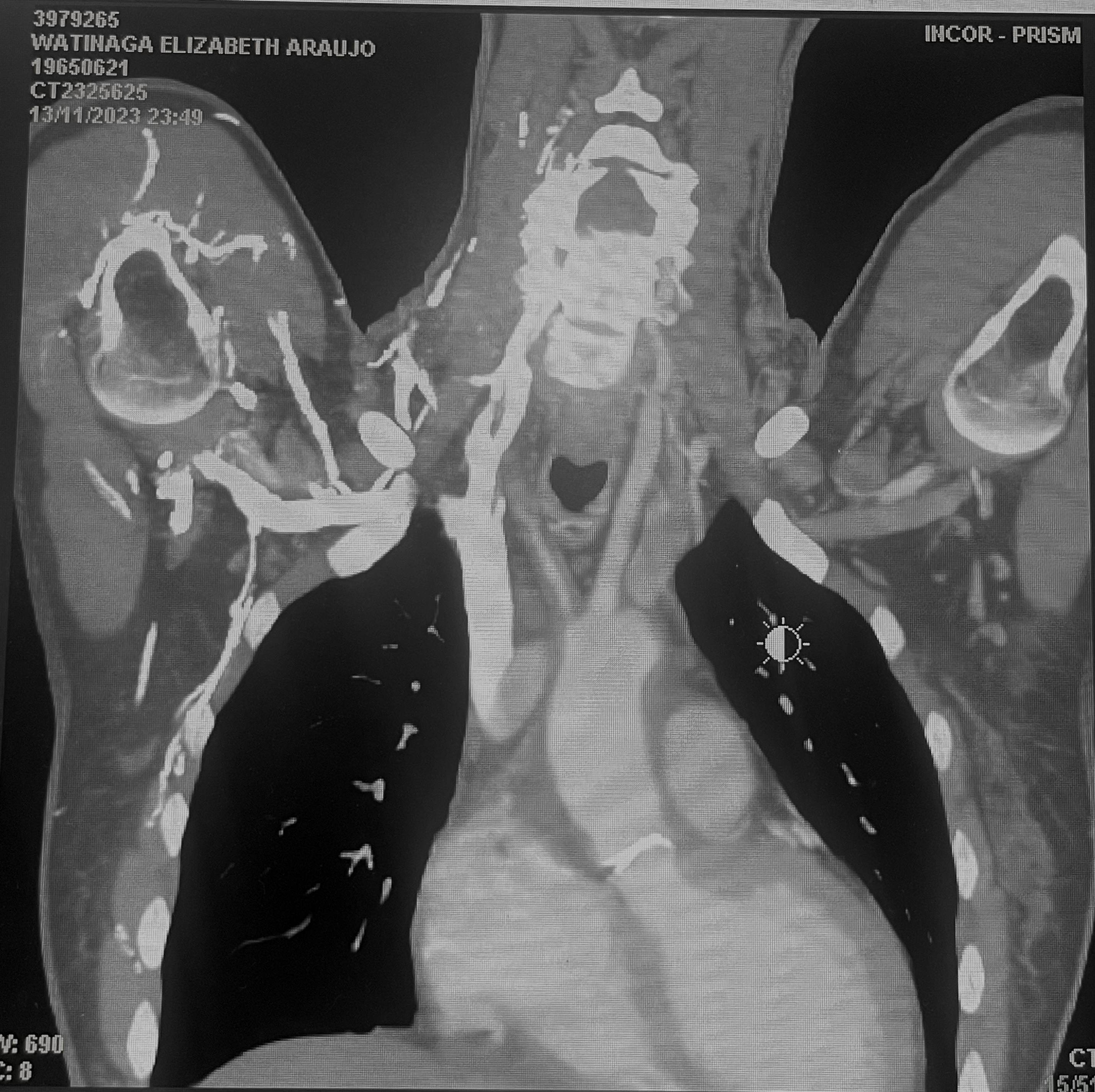 Angiotomografia de aorta