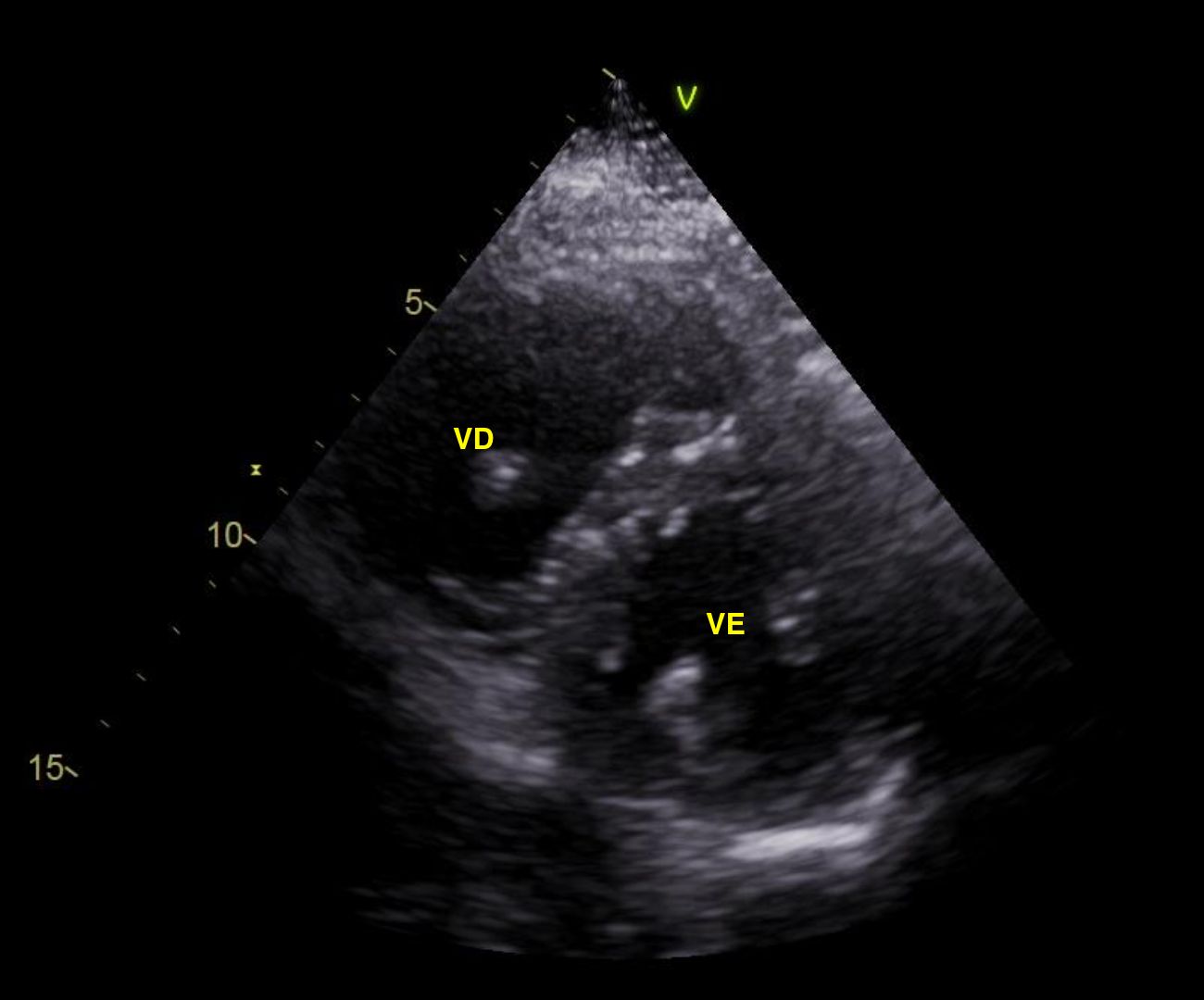 Fig4: comparativo, redução do VD e normalização do septo interventricular após trombólise