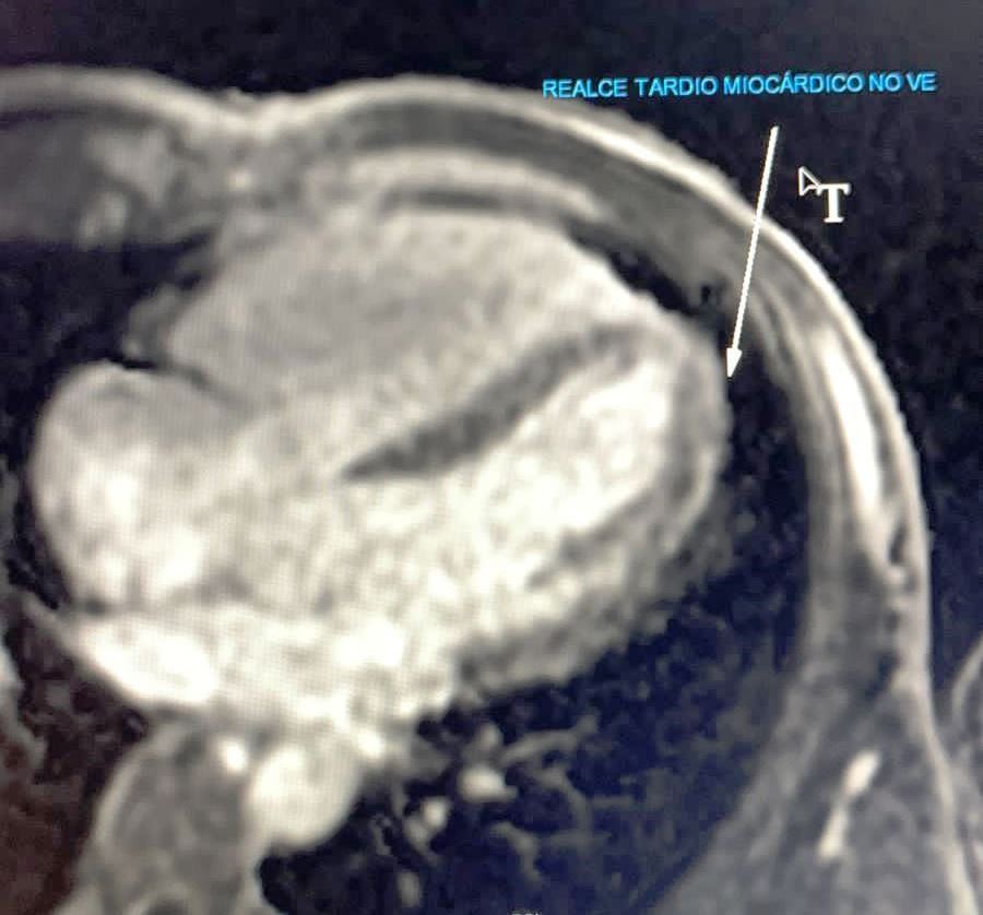 Ressonancia magnética cardíaca evidenciando realce tardio