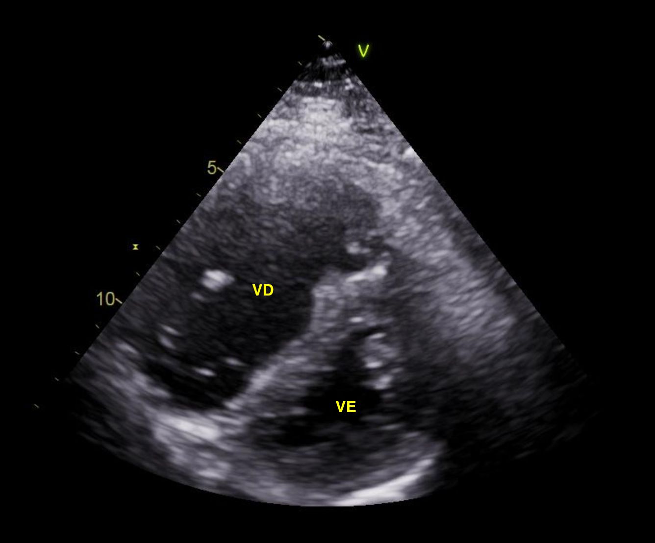 Fig3: Paraesternal eixo curto. Aumento importante do VD, retificação do septo, VE em "D-shape", sobrecarga pressórica de VD