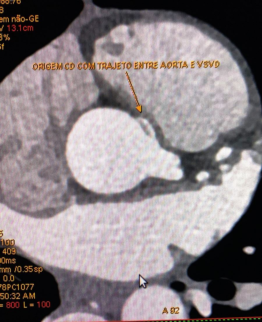 Angiotomografia coronária evidenciando origem anomala da coronária direita, entre a aorta e via de saída do ventrículo direito