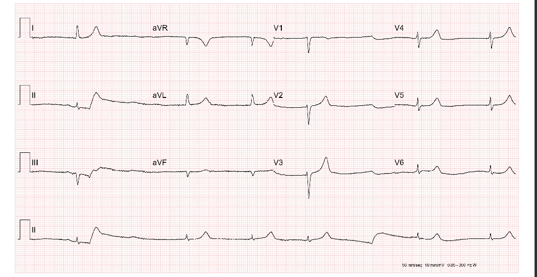 Figura 1: ECG mostra fibrilação atrial de baixa resposta ventricular.