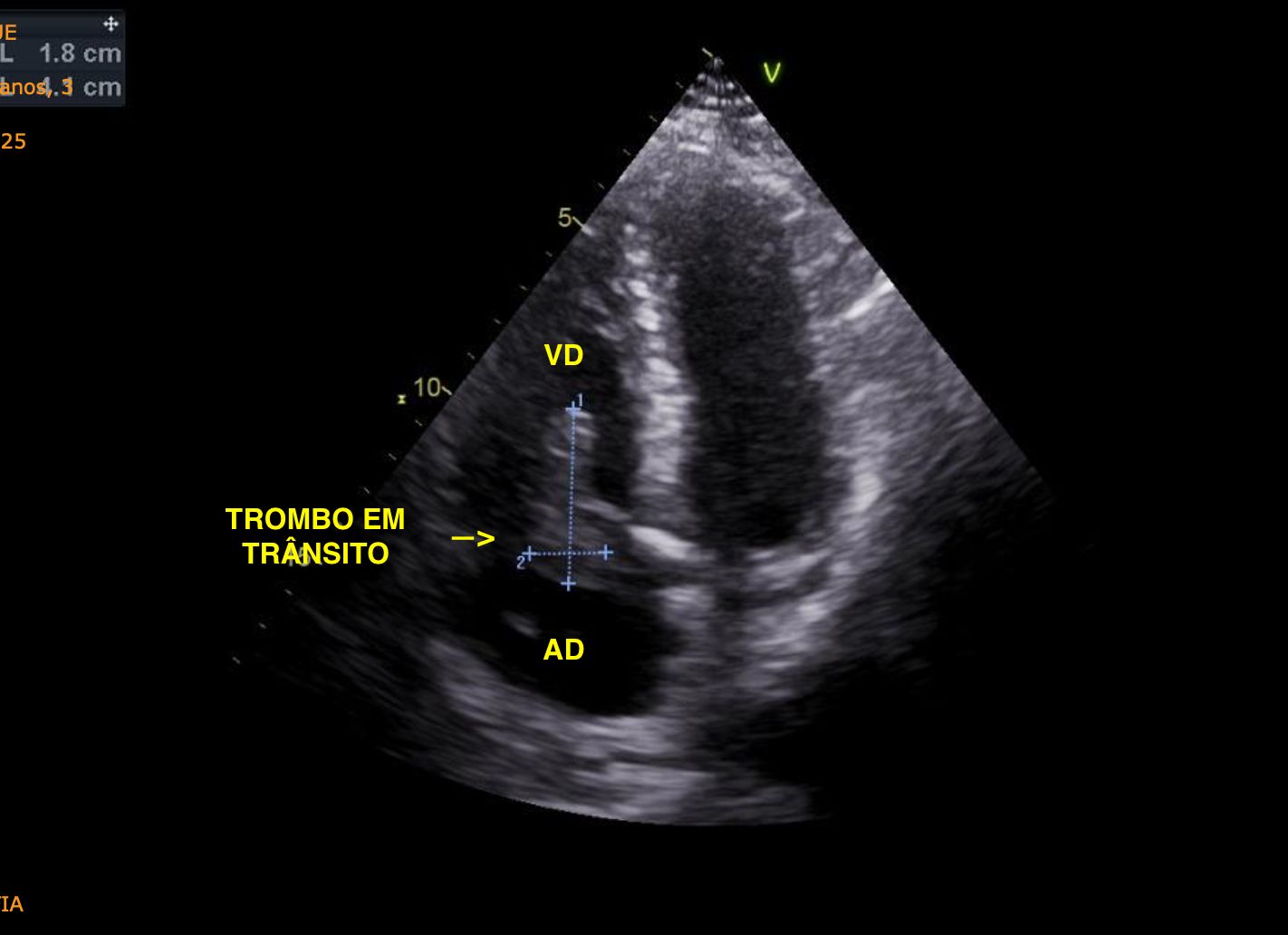 Fig1: Apical 4c ; trombo em transito no interior do atrio direito e do ventriculo direito