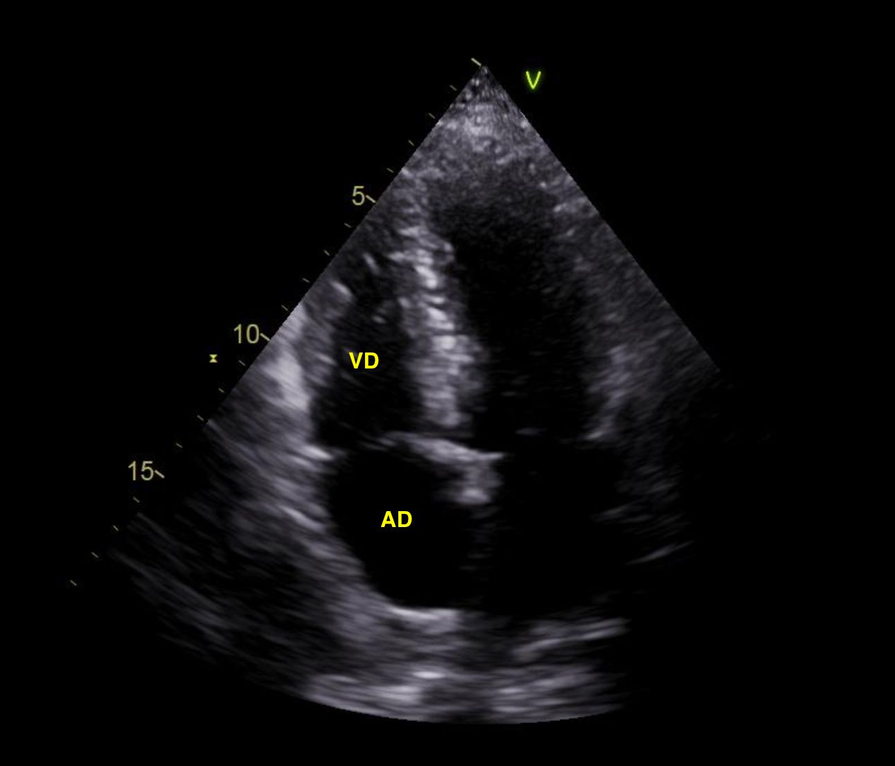 Fig2: apical 4c ; ausencia de trombo intracavitário após trombólise